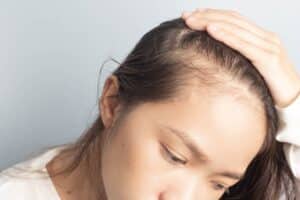 Young,Women,Stressed,And,Having,Hair,Loss,,Thinning,Hair