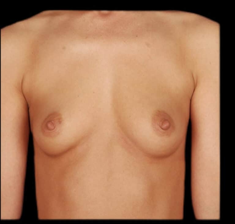 Before Image: Breast Augmentation - front