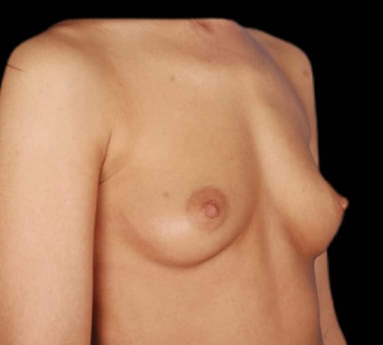Before Image: Breast Augmentation - right-front-oblique