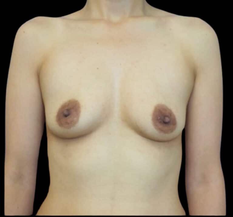 Before Image: Breast Augmentation - front