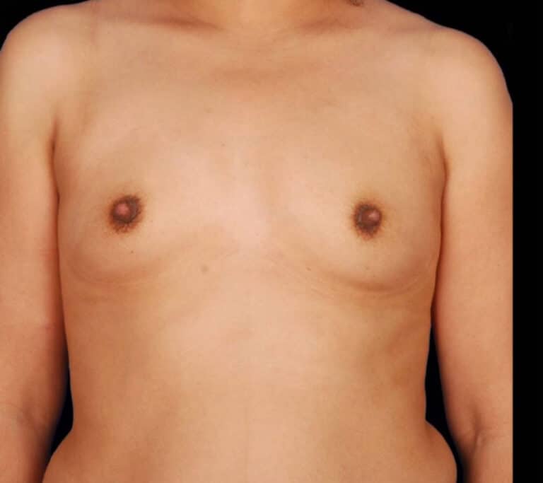 Before Image: Breast Augmentation - front