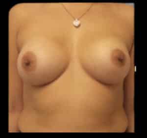 After Image: Breast Augmentation