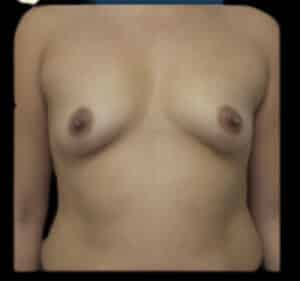 Before Image: Breast Augmentation