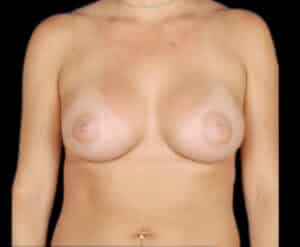 After Image: Breast Augmentation