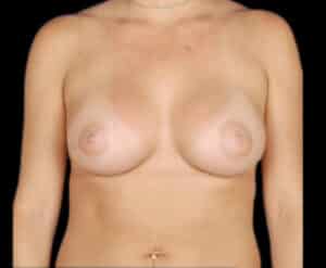 Breast Augmentation