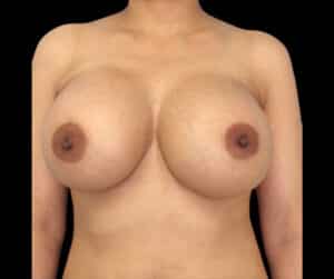 After Image: Breast Augmentation