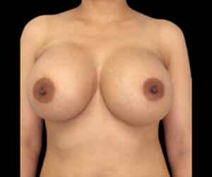 Breast Augmentation