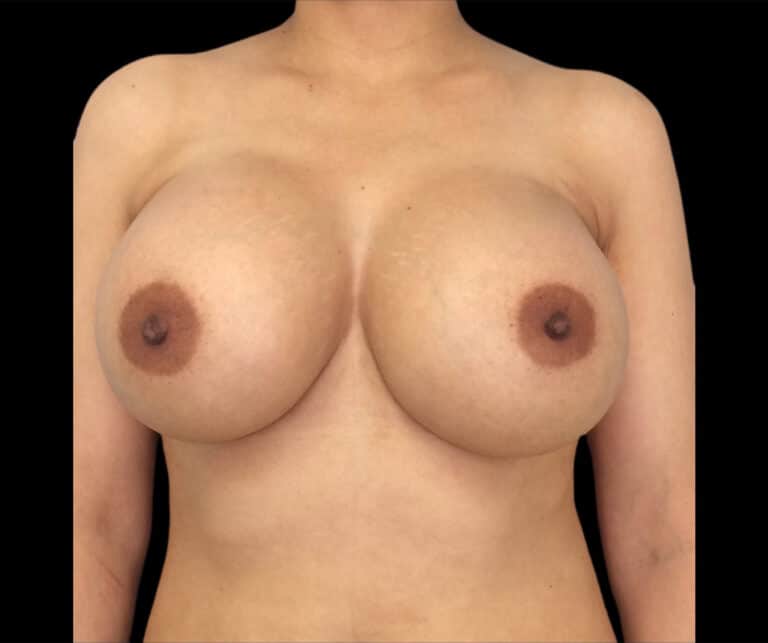 After Image: Breast Augmentation - front