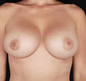 After Image: Breast Augmentation