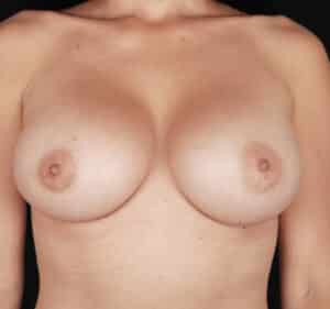 Breast Augmentation