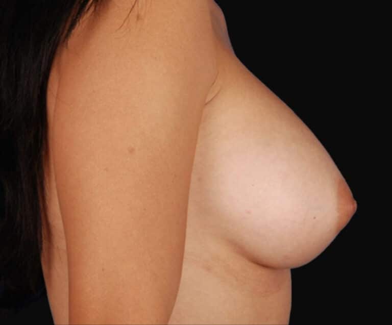 After Image: Breast Augmentation - right-side