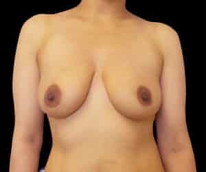 Before Image: Breast Augmentation