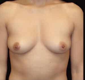 Before Image: Breast Augmentation