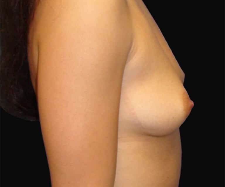 Before Image: Breast Augmentation - right-side