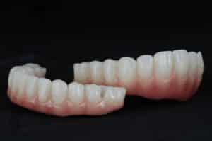 Ceramic,Denture,All on four,And,All on five,On,Dental,Implant